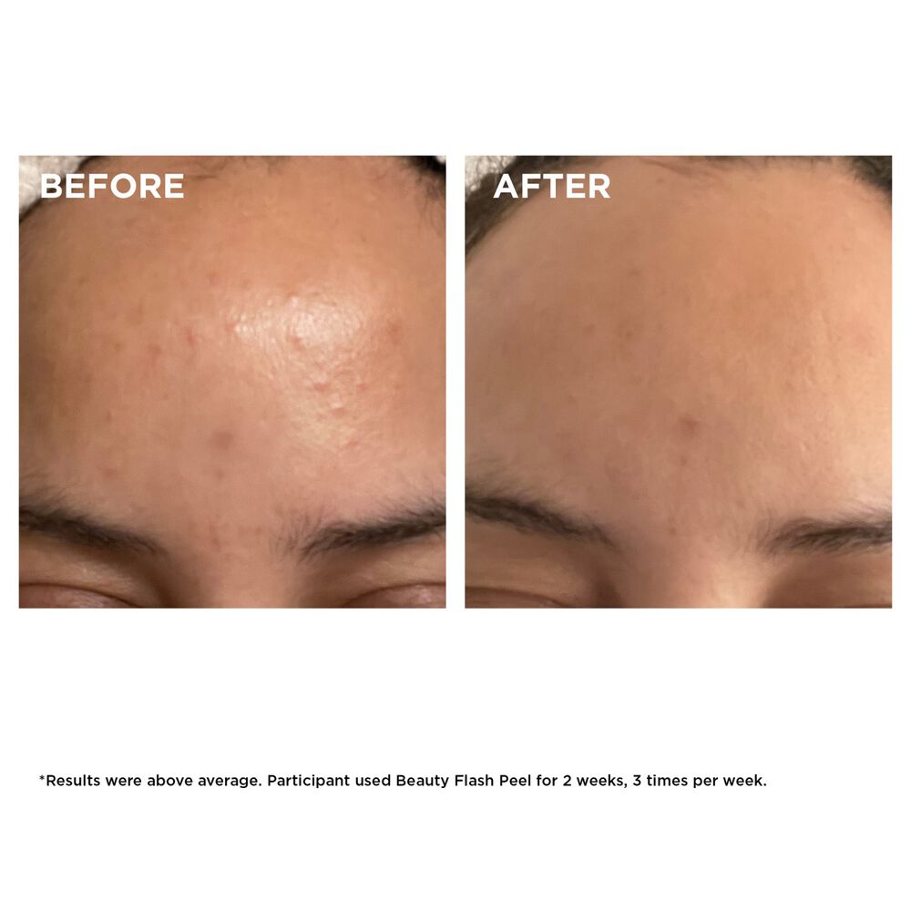 Beauty Flash Peel Face Exfoliator - At-Home Facial Skin Peel